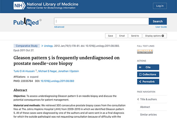 Gleason pattern 5 is frequently underdiagnosed on prostate needle-core biopsy